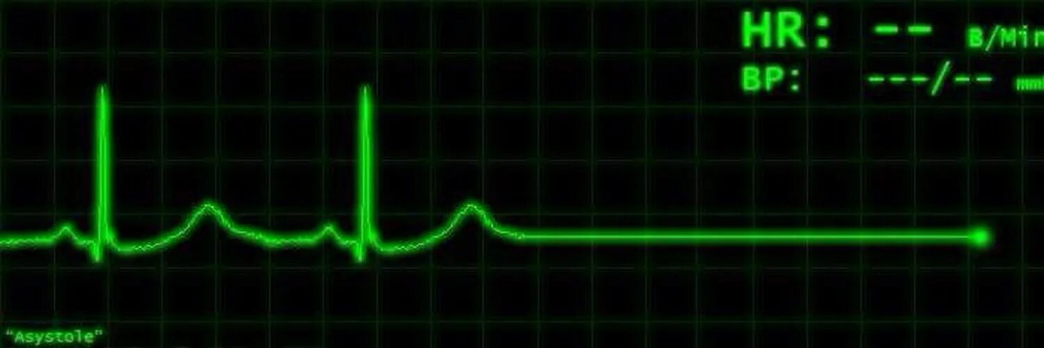 Пульс остановился. Смерть на ЭКГ асистолия. Прямая линия на кардиограмме. Кардиограмма остановки сердца. Остановка сердца на ЭКГ.