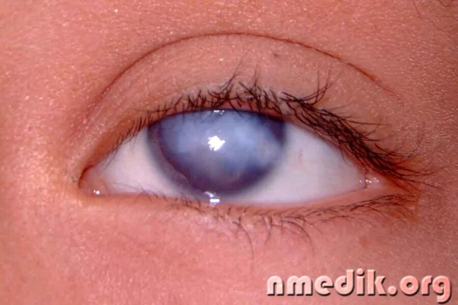 Гонобленнорейный конъюнктивит. Пленка на глазу у ребенка. Пленка на глазу у ребенка. Пленка на глазах у новорожденных детей. Прозрачная пленка на глазу.