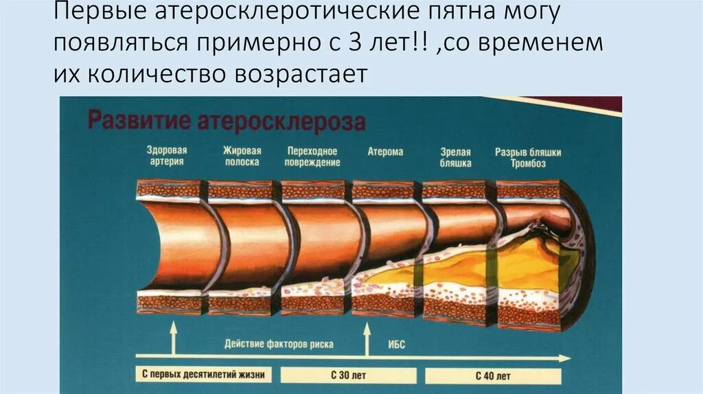 Начинающийся атеросклероз. Стадии развития атеросклероза. атеросклероз развивается в результате нарушения:. атеросклероз это простыми словами.