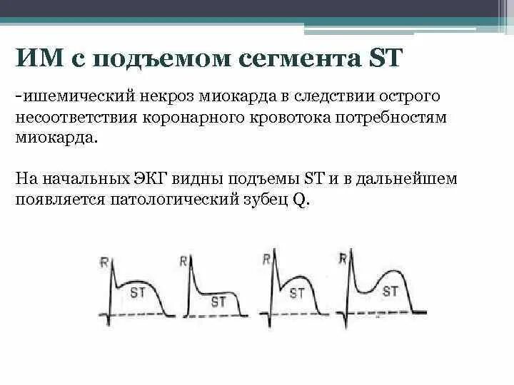 Экг подъем. Окс без подъема сегмента ст. Подъем сегмента St на ЭКГ v1 v2. Инфаркт миокарда с подъемом сегмента St ЭКГ. Подъем сегмента ст на ЭКГ.