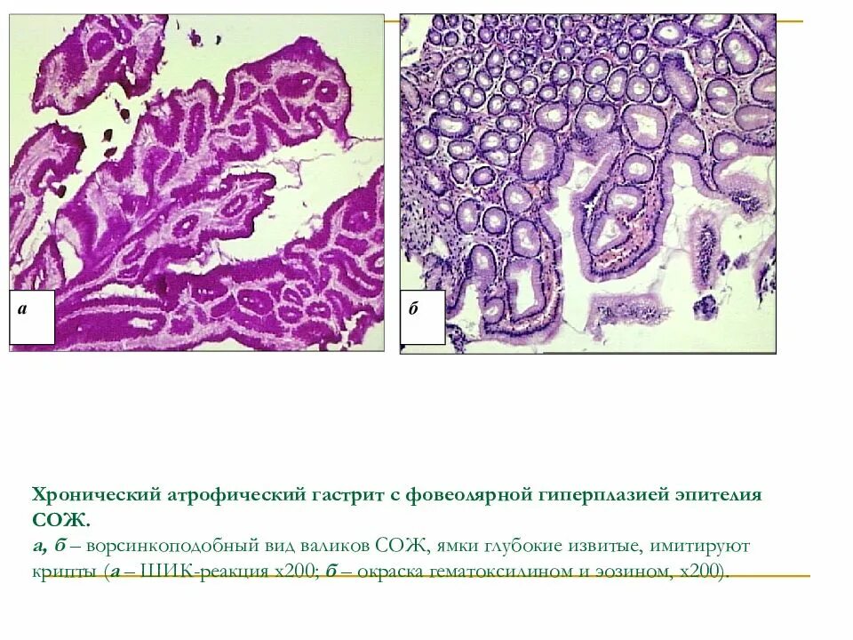 Ворсинчатый полип толстой кишки. Криптоспоридиоз гистология. Атипическая гиперплазия молочной железы гистология. Фовеолярная гиперплазия гистология. Эпителиоидно клеточная гранулема.