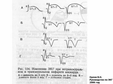 Рубцовые изменения на экг