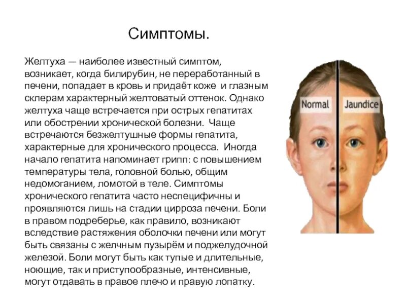 Признаки желтухи у взрослых. Признаки механической желтухи. Причины появления желтухи. Признаки желтухи у взрослых. Механическая желтуха печеночная.