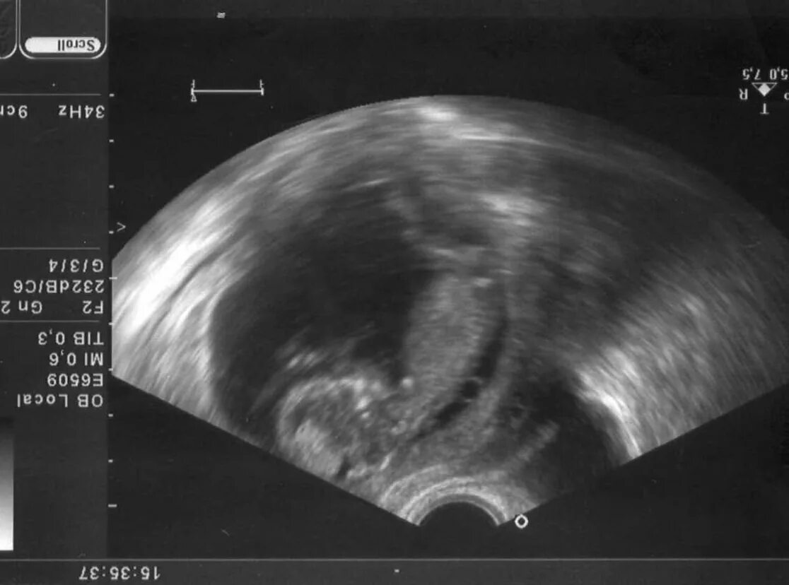Ктр эмбриона форум. 5 мм. Размер плодного яйца на 4-5 неделе беременности. Копчико-теменной размер в 12 недель. Ктр 6.