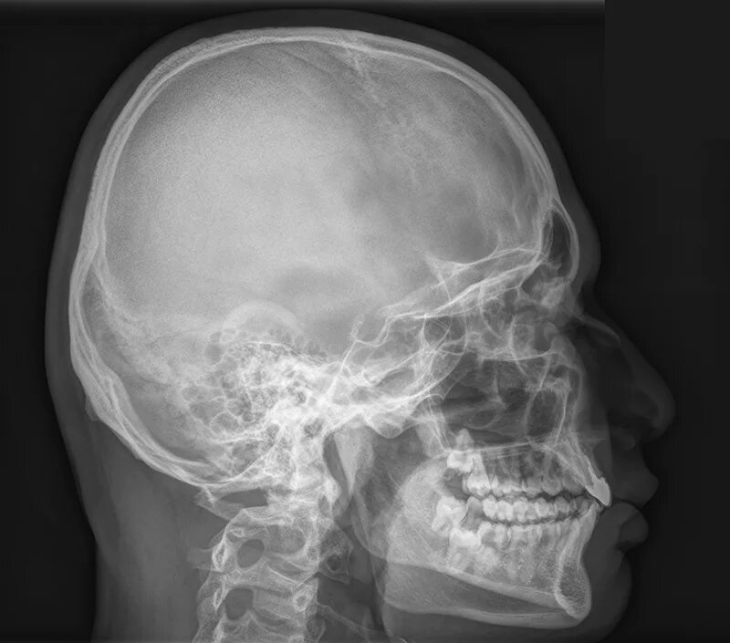 Рентген черепа сотрясение. Остеосклероз черепа рентген. Сотрясение мозга рентген.