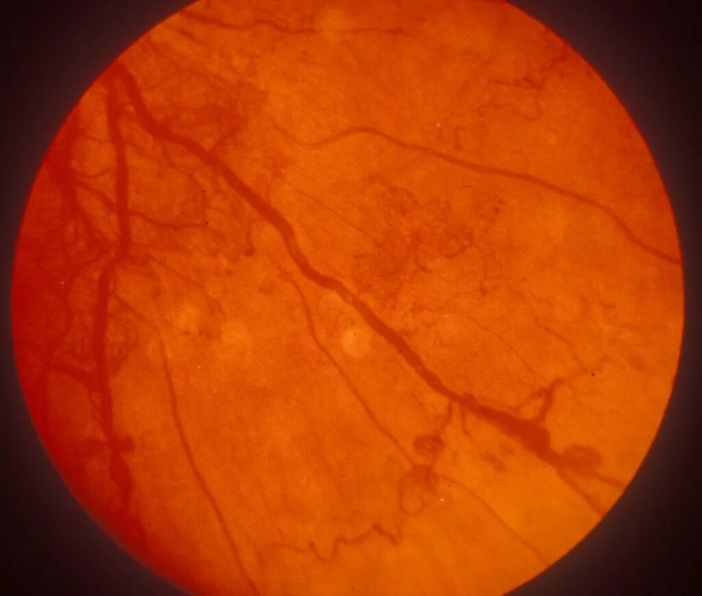 Атеросклеротическая ретинопатия. Пролиферативная диабетическая ретинопатия.