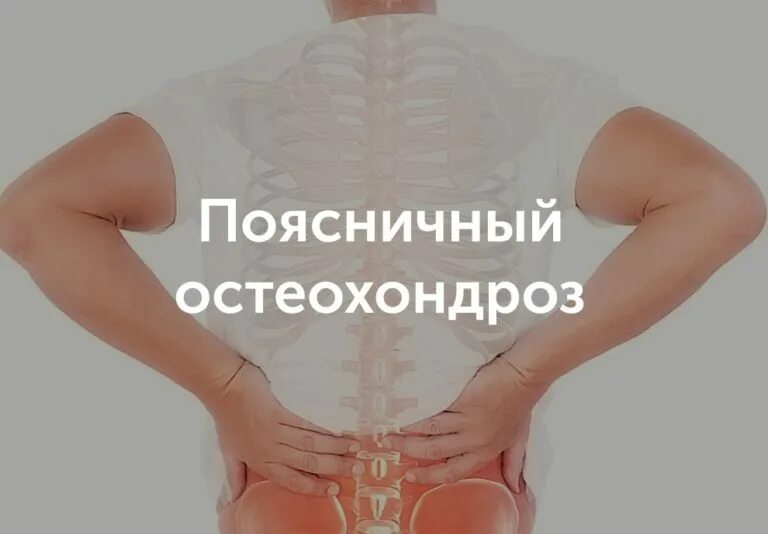Как лечить поясничный остеохондроз у женщин. Поясничный остеохондроз. поясничный остеохондроз симптомы. остеохондроз поясничного отдела симптомы у женщин. поясничный хондроз симптомы у женщин.
