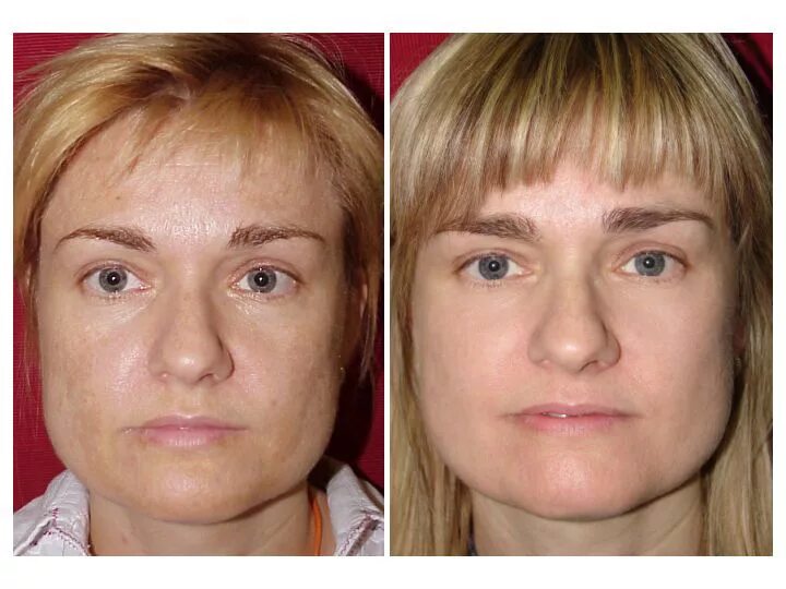 Минусы лазерного омоложения. Fotona 4d аппарат. Фракционный фототермолиз со2 лазером. Фракционный фототермолиз со2 реабилитация. Минусы лазерного омоложения.