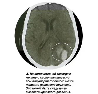 Кровоизлияние в височную долю коры головного мозга