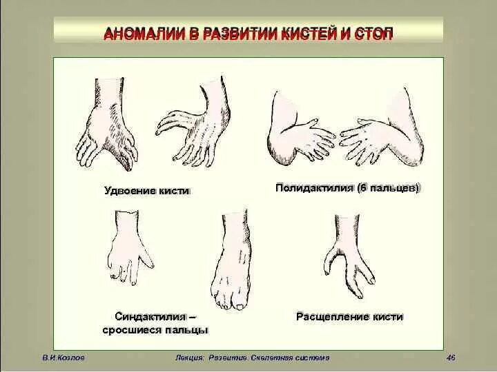 Аномалии развития называются. Врожденная аномалия развития кистей. Аномалии развития костей кисти. Полидактилия кисти классификация.