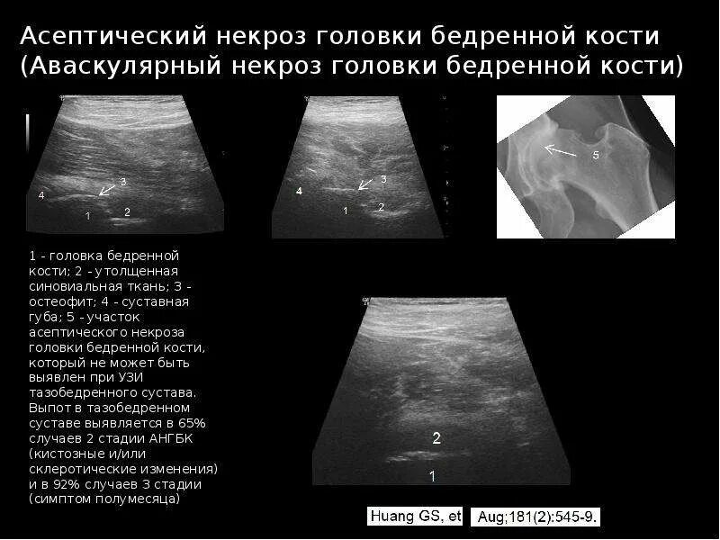 Делают ли узи тазобедренного сустава. Исследование тазобедренного сустава по узи. шеечно-капсулярное пространство на узи. шеечно-капсулярное пространство тазобедренного сустава.