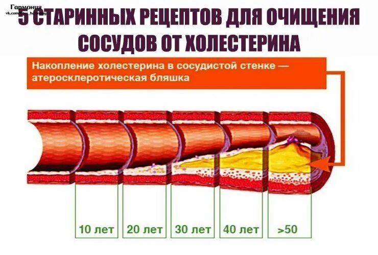 Атеросклероз лечение домашними средствами