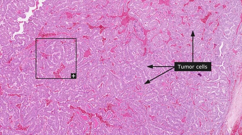 Папиллярная карцинома гистология. Папиллярная аденома щитовидной железы гистология. Папиллярная карцинома щитовидной железы гистология. Фолликулярная карцинома щитовидной железы гистология. Папиллярный рак после операции