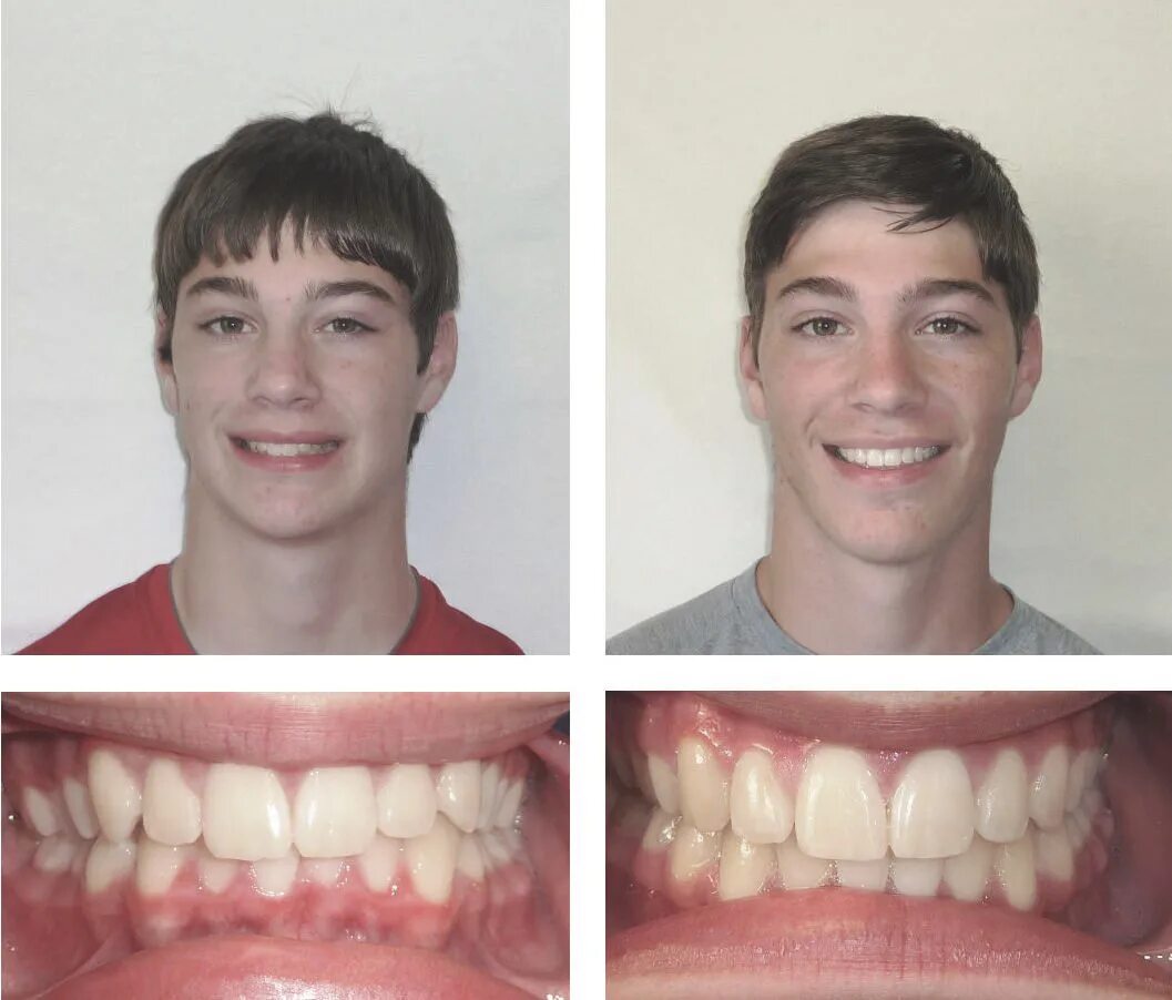 Исправление прикуса брекетами до и после. Брекеты для выравнивания зубов. Изменения после брекетов