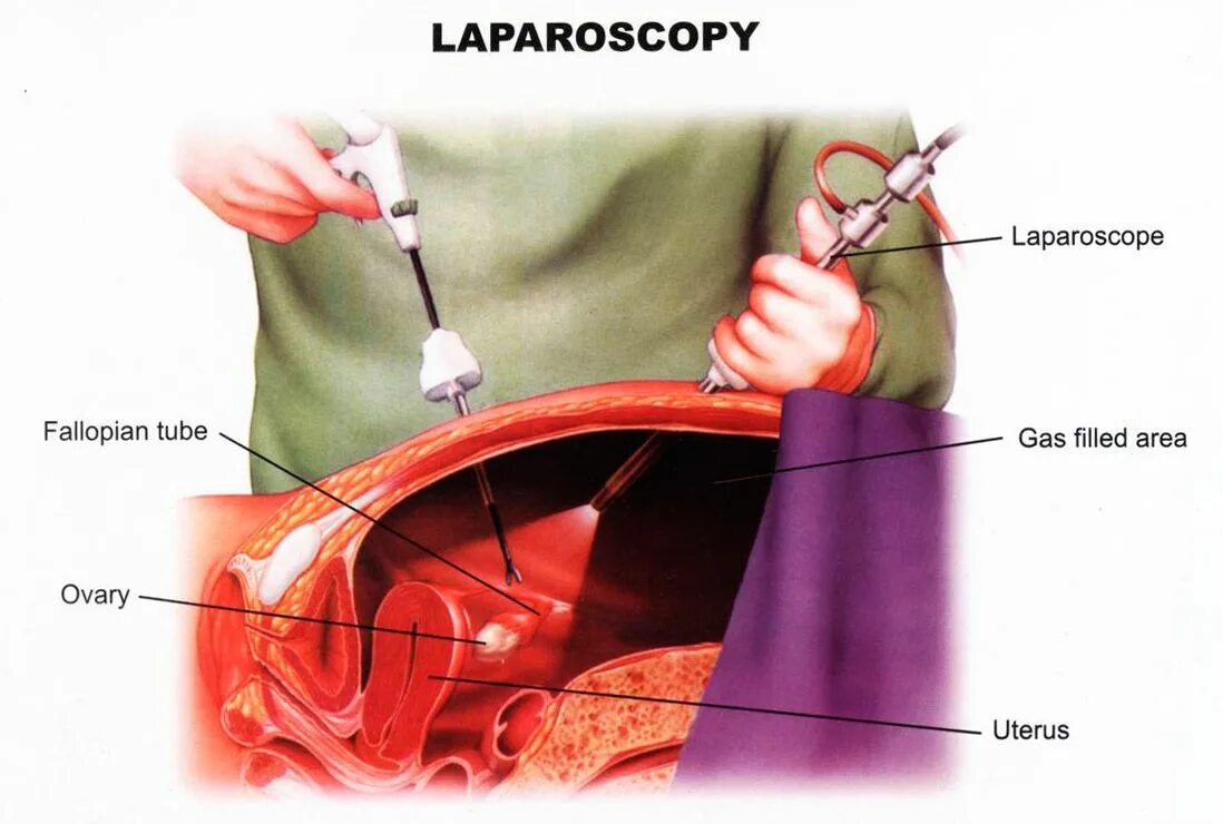 Лапароскопия маточных трубок. Операция внематочной беременности лапароскопии. Лапароскопия непроходимость труб. Операция лапароскопия маточных труб. Болит правая сторона яичников