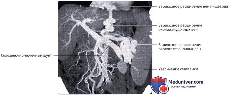 Портальная гипертензия на кт. Варикозное расширение вен пищевода кт. Компьютерная томография пищевода снимки.