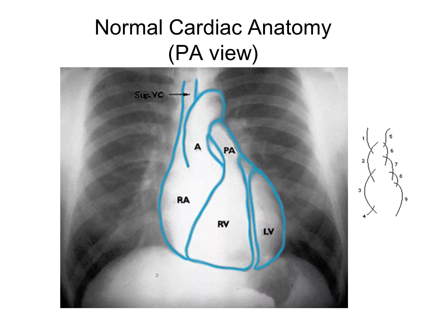 Дуга аорты на рентгенограмме. Расположение сердца на рентгене. Дуги сердца на рентгенограмме. Легкие в прямой проекции