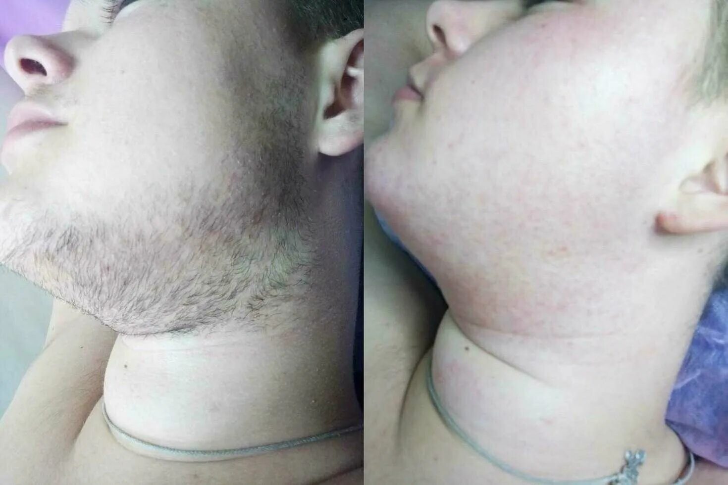 мужская электроэпиляция. мужская эпиляция до и после. восковая депиляция. электроэпиляция зоны бикини. лазерная эпиляция лица для мужчин.