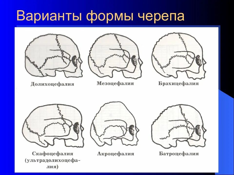 Варианты формы черепа. Долихоцефалия мезоцефалия брахицефалия формы черепа. Формы головы человека брахицефалия, мезоцефалия. Мезоцефалическая форма черепа ребенка. Формк черепа.