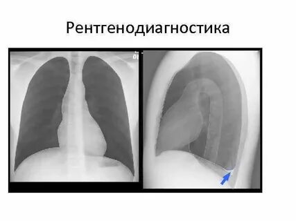 Правосторонний плеврит