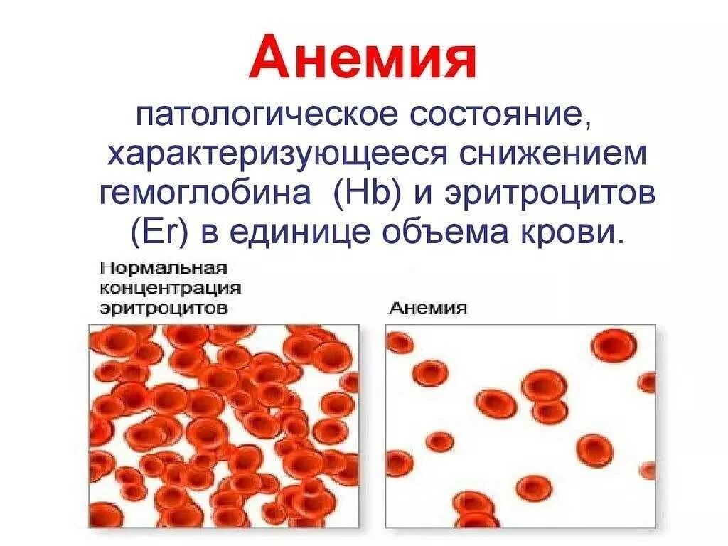 Анемия больные. Эритроциты при снижении гемоглобина. Гемоглобин и эритроциты при железодефицитной анемии. Железодефицитная анемия снижение гемоглобина. Анемия при гемоглобин 107.