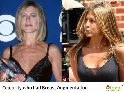 Breast augmentation by silicon implants 