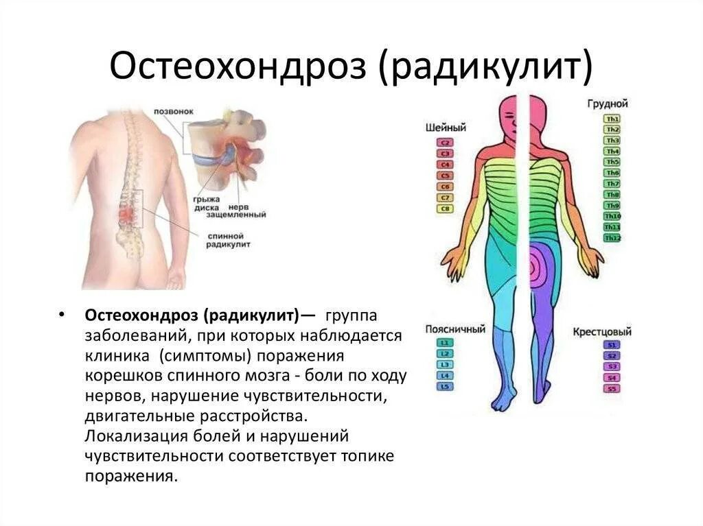 Симптомы поясничной радикулопатии. Радикулит симптомы. Радикулопатия поясничного отдела симптомы. Локализация остеохондроза.