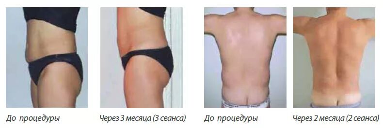 Акваликс до и после фото - ViktoriaFoto.ru