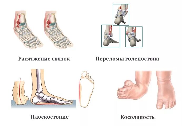 Болит голеностопный сустав что делать. Болит голеностоп причины. Ноет голеностопный сустав. Болит голеностопный сустав после бега.