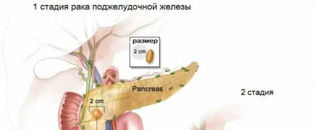 Вылечили рак 4 стадии с метастазами. Карцинома головки поджелудочной железы. Онкология поджелудочной железы. Опухоли поджелудочной железы 4 стадии. Живут ли без поджелудочной железы.