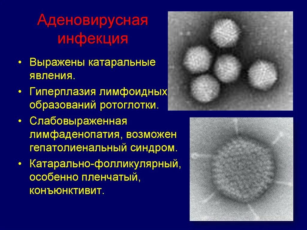 Катаральный грипп. Аденовирусный кератит. Аденовирусная инфекция. Аденовирусная инфекция катараральные явления. Аденовирусный кератит исследование.