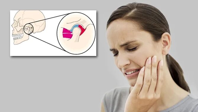 От чего может болеть челюсть. Актиномикотический артрит ВНЧС. Артрит височно челюстного сустава симптомы. Острый артрит височно-нижнечелюстного сустава.
