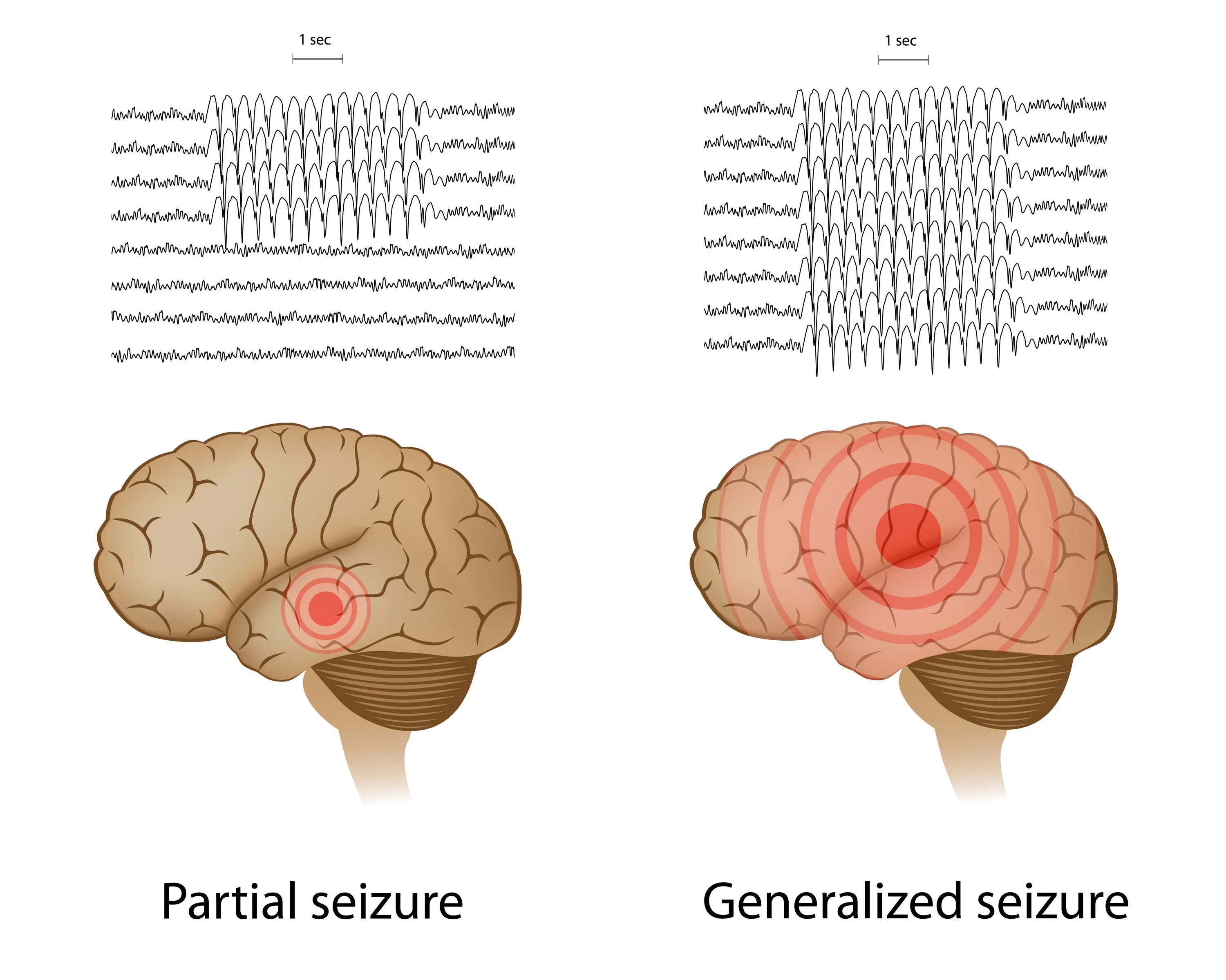 Фокальная и генерализованная эпилепсия. Парциальные и генерализованные припадки. Парциальные и генерализованные эпилептические припадки. Парциальная эпилепсия. Фокальные припадки