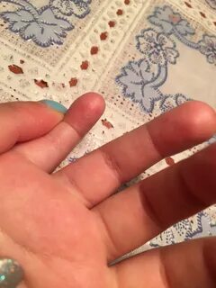 Палец без подушечки