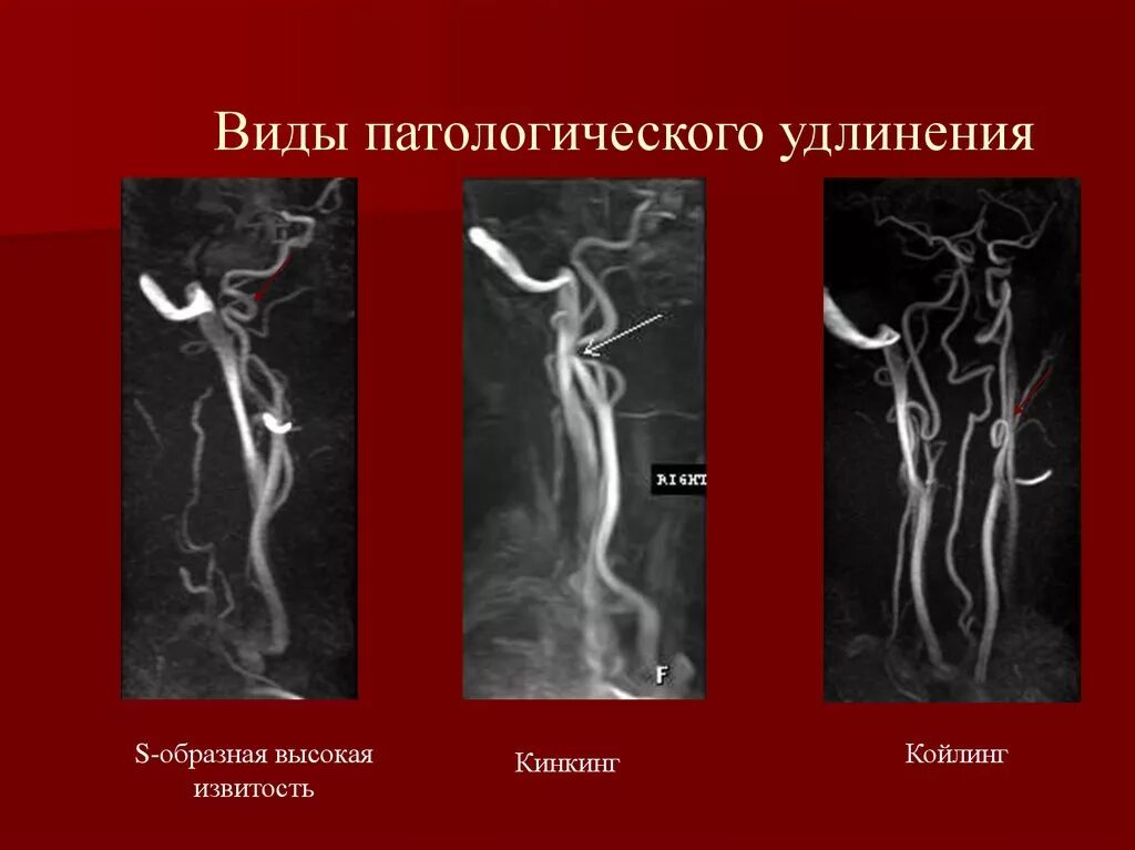 Изгиб вса. Кинкинг и койлинг сосудов. Койлинг и кинкинг на кт. Кинг Кинг внутренней сонной артерии. Койлинг позвоночных артерий.