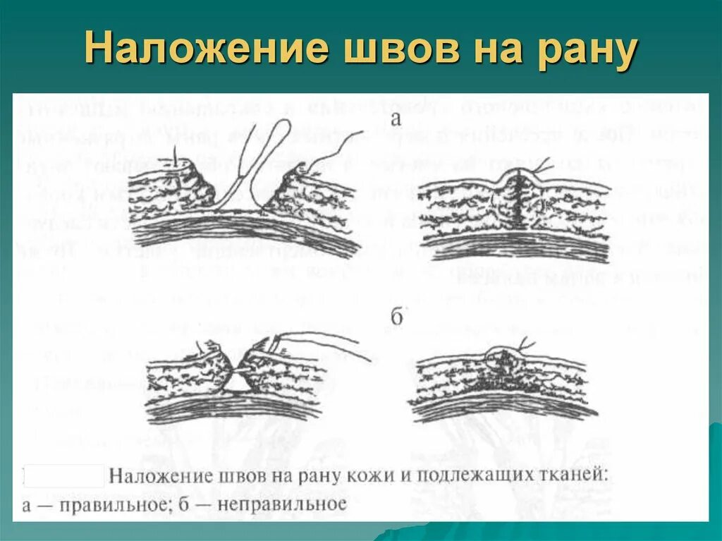 Алгоритм операции наложения. Техника накладывания швов на рану.