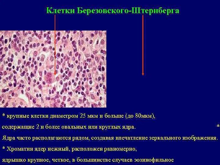 Рид штернберга. Клетки Рида Березовского Штернберга. Многоядерные клетки Березовского-Рид-Штернберга. Клетки Березовского-Штернберга гистология. Лимфома Ходжкина клетки Березовского-Штернберга-Рид.