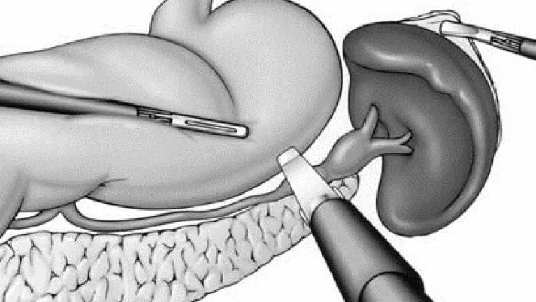 Операции на селезенке. Спленэктомия селезенки. Спленэктомия операция. Атипичная резекция селезенки.