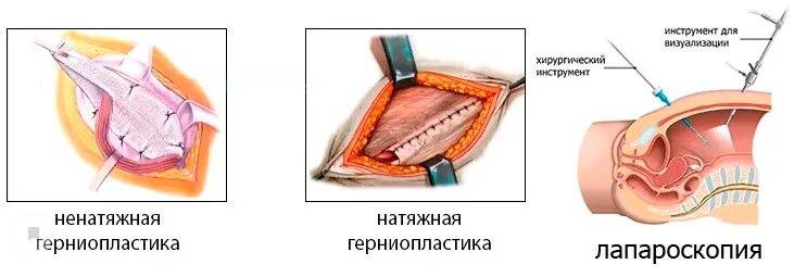 Паховая грыжа сколько больничный. Натяжная герниопластика пупочной грыжи. Натяжная герниопластика паховой грыжи. Операция герниопластика. Герниопластика грыжи белой линии живота.