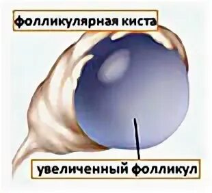Фолликулярная киста яичника что делать