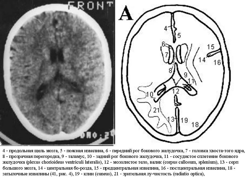 Обызвествление серпа головного кт. Боковые желудочки головного мозга анатомия на кт. Кт головного мозга аксиальный срез. Базальные цистерны головного мозга кт. Расширение боковых рогов