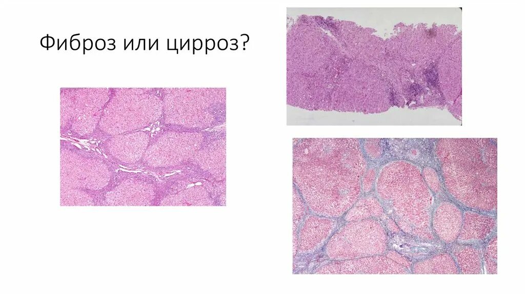 Фиброз ковид. Фиброз соединительной ткани.