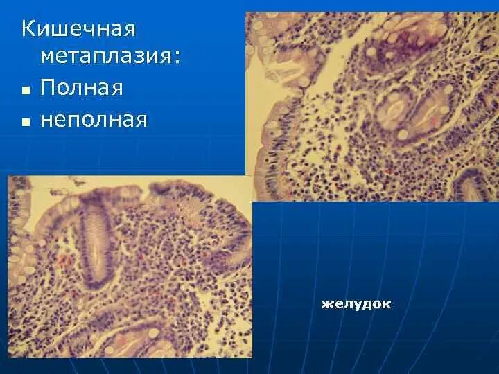 Метаплазия желудка отзывы. Кишечная метаплазия микропрепарат. Полная кишечная метаплазия гистология. Метаплазия желудка гистология. Метаплазия слизистой оболочки желудка.