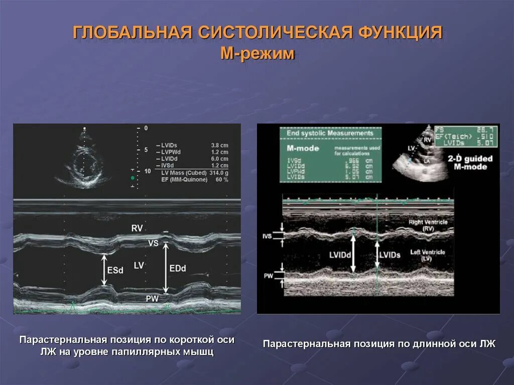 Систолическая функция ЭХОКГ. Оценка систолической функции левого желудочка. Систолическая функция желудочков. Оценка систолической функции левого желудочка по ЭХОКГ.