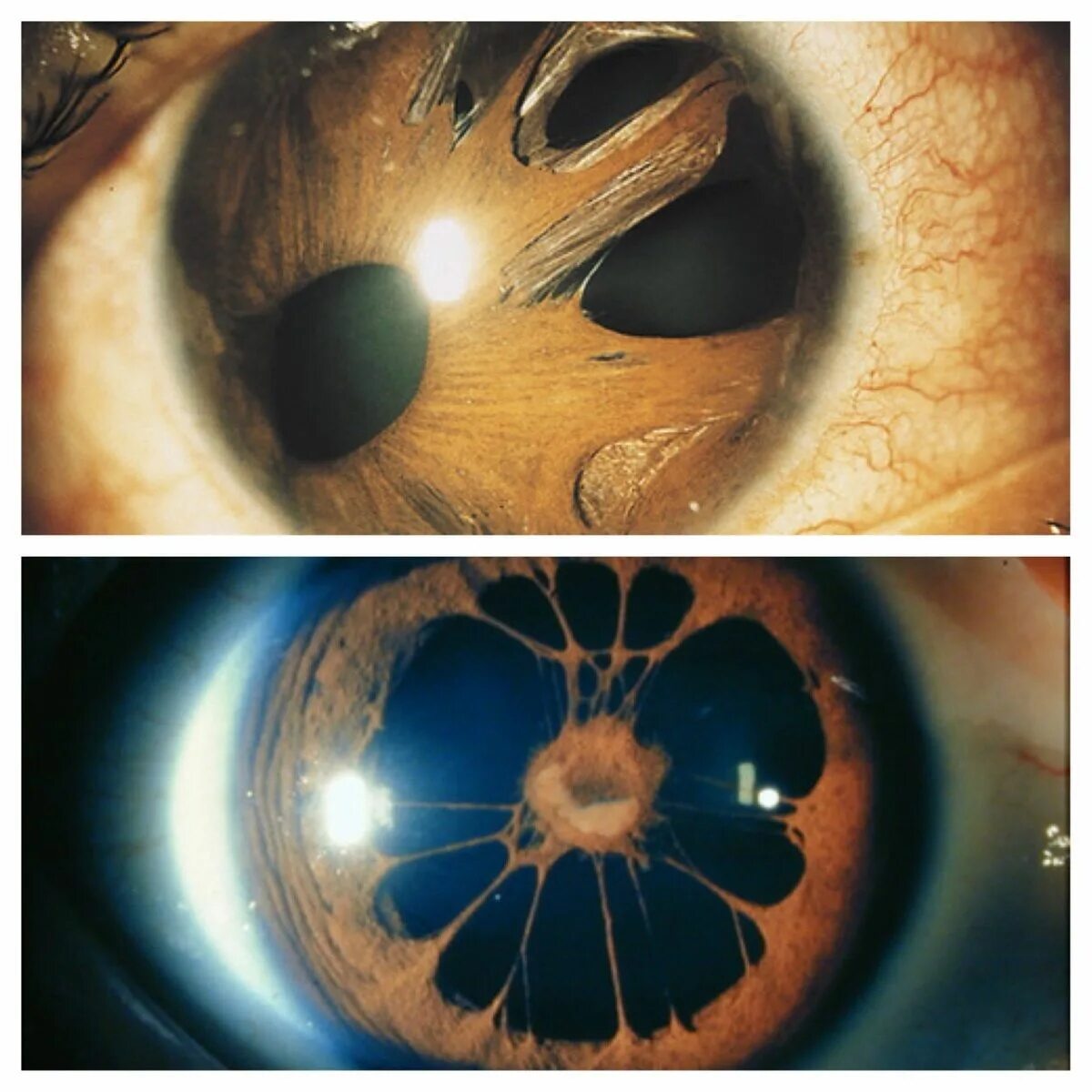 Поликория аномалия глаз. Поликория радужной оболочки.