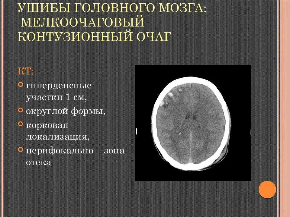 Травма мозга очаговая. Очаги ушиба головного мозга на кт. Ушиб головного мозга 2 типа на кт. Контузионный очаг мозга кт. Контузионные очаги головного мозга на кт классификация.