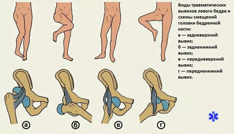 Почему щелкают ноги. Подвывих тазобедренного сустава классификация. Вывих тазобедренного сустава. Передненижний вывих бедра. Врожденный вывих бедра классификация.