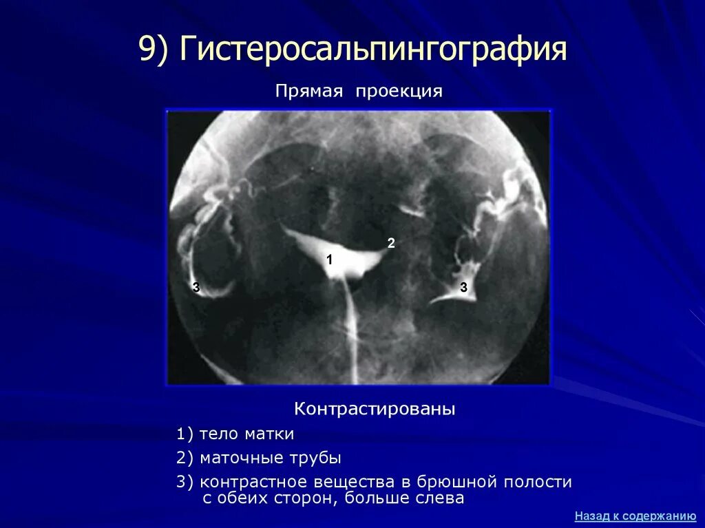 Можно забеременеть при непроходимости труб. МСГ маточных труб норма. Непроходимость маточных труб УЗИ. ГСГ снимок маточных труб. ГСГ маточных труб норма.