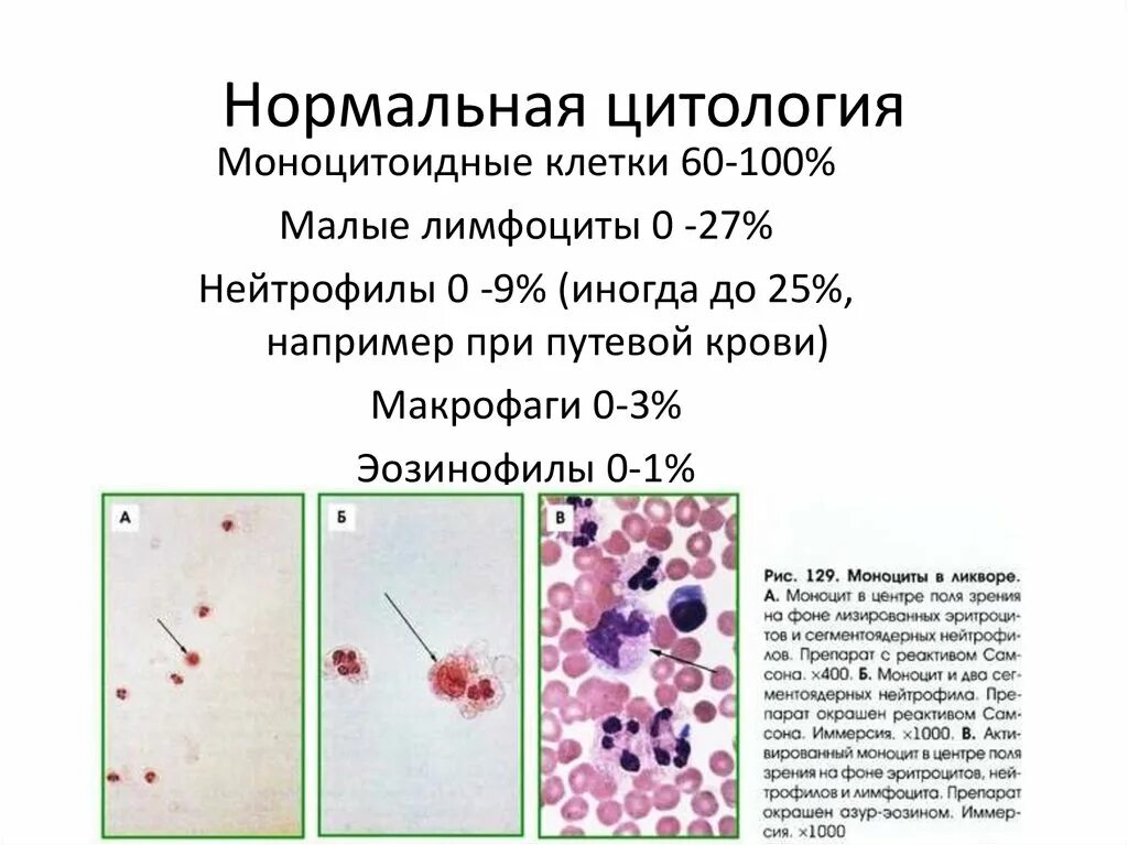 Исследование спинномозговой жидкости лимфоциты. Лимфоциты и нейтрофилы в ликворе. Клетки спинномозговой жидкости макрофаги. Клеточный состав спинномозговой жидкости в норме. Макрофаги и нейтрофилы