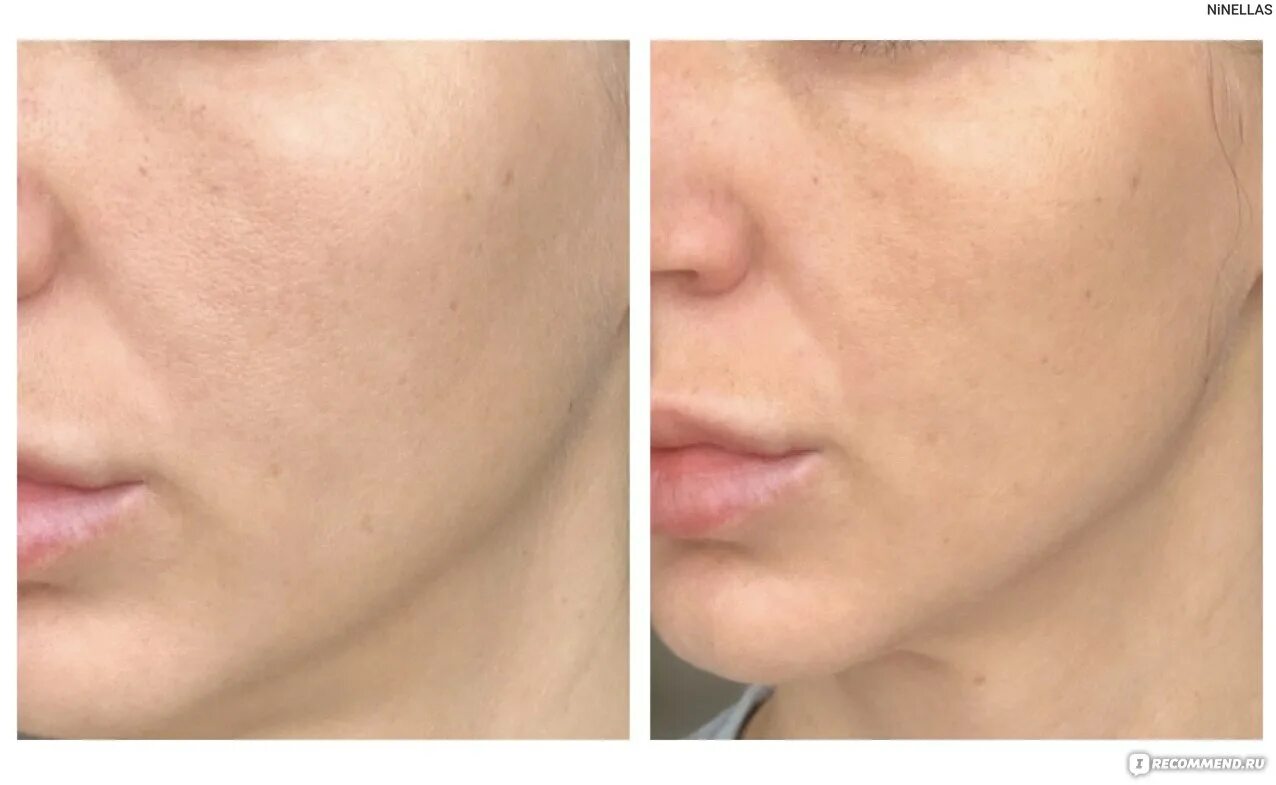 Axis y pha resurfacing glow peel. Энзим пилинг нл. glow peel мультикислотный пилинг. пилинг мультикислотный для лица до и после. энзимный пилинг до и после.